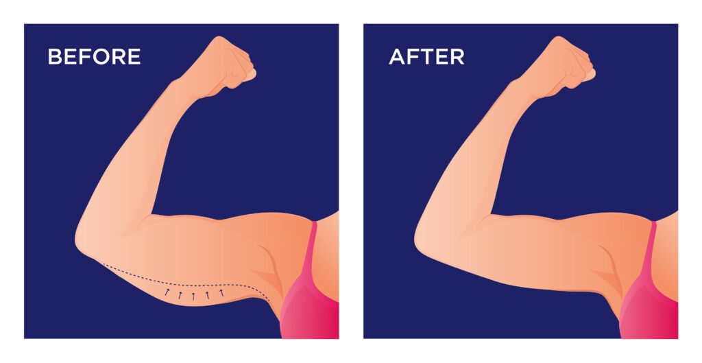 Arm,With,Excess,Skin,Before,And,After,Surgical,Operation.,Saggy muscle loss